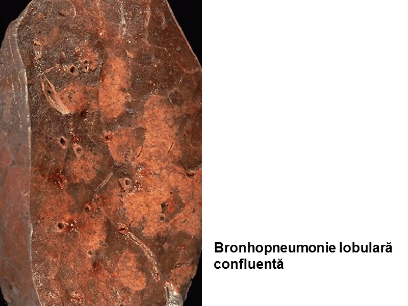Bronhopneumonie lobulară  confluentă